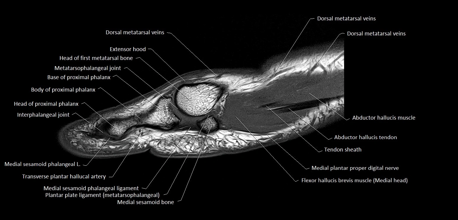 Hallux or big toe sagittal anatomy 3T MRI image 7.webp